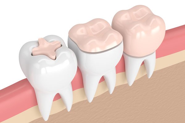 Dental restoration treatment with crowns and tooth repair