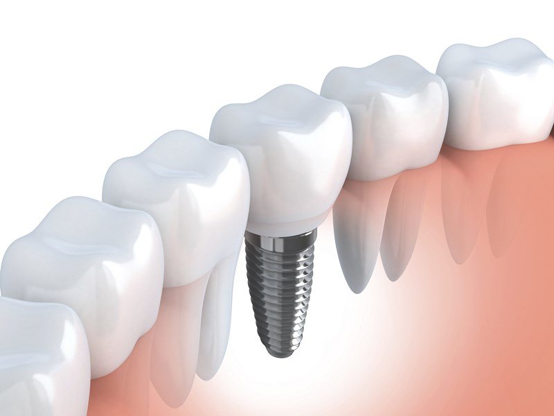 Dental implant and denture treatment planning