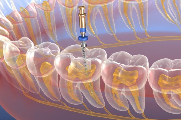 Root canal evaluation for tooth pain