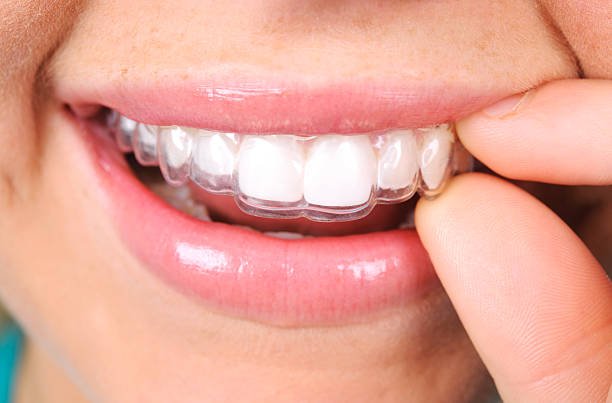 Clear aligner orthodontic treatment planning