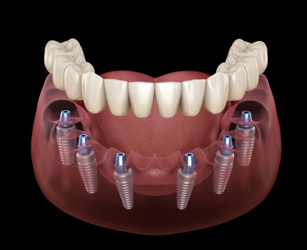 All-on-X full-arch dental implant bridge supported by six implants in the lower jaw